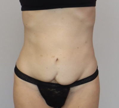 3875-imageset_1-before
