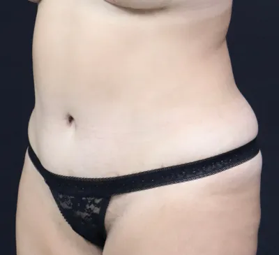 tummy-tuck-01_4of6