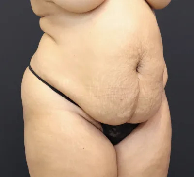 tummy-tuck-03_3of6