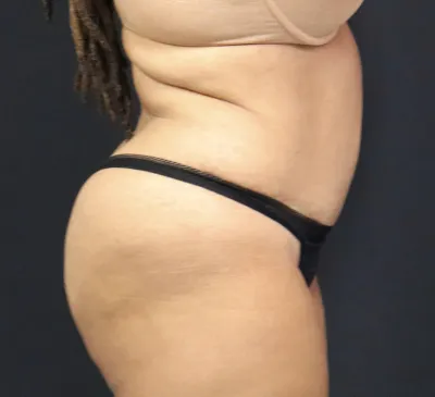 tummy-tuck-03_6of6