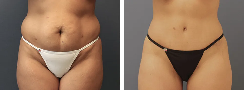 Before and After a tummy tuck surgery performed by expert plastic surgeon Dr. Maakan Taghizadeh at his office in Owings Mills, MD.