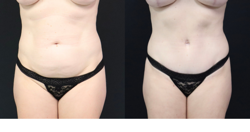 tummy tuck