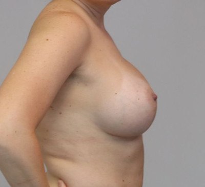 Breast Augmentation/Lift