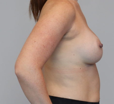 Revision Breast Augmentation