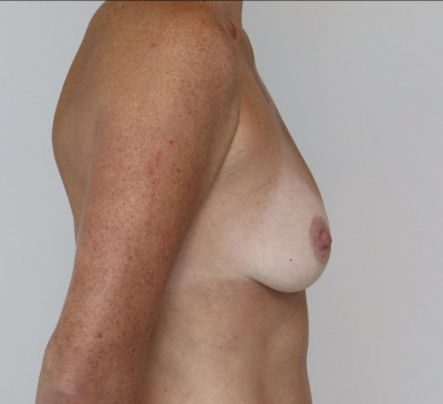 Breast Augmentation