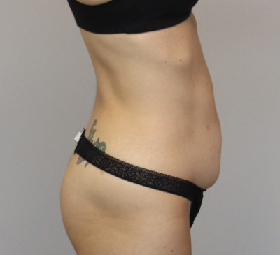 Tummy Tuck