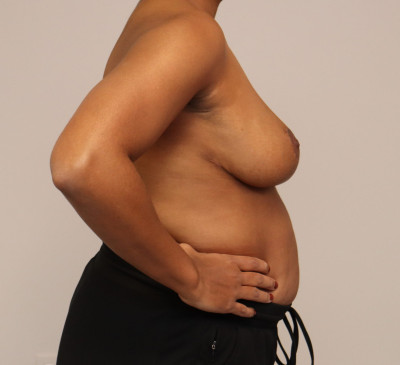 Breast Reduction