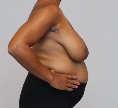 Breast Reduction